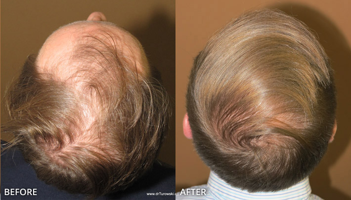 FUE Hair Transplantation – Before and After Pictures