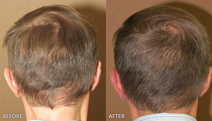 FUE Hair Transplantation – Before and After Pictures