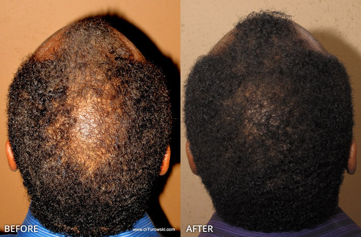 FUE Hair Transplantation – Before and After Pictures