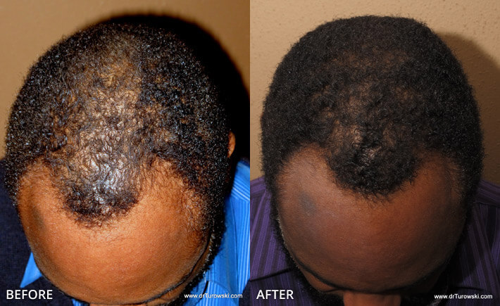 FUE Hair Transplantation – Before and After Pictures