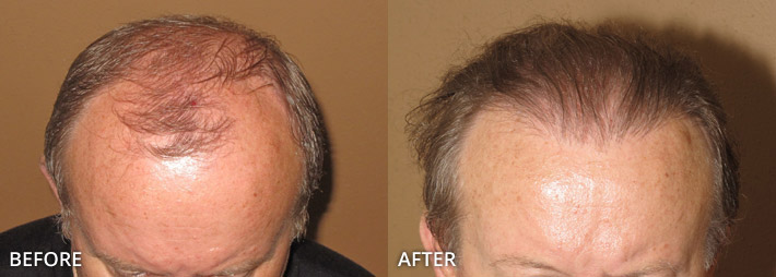 FUE Hair Transplantation – Before and After Pictures