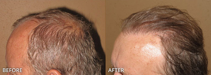 FUE Hair Transplantation – Before and After Pictures