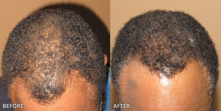 FUE Hair Transplantation – Before and After Pictures