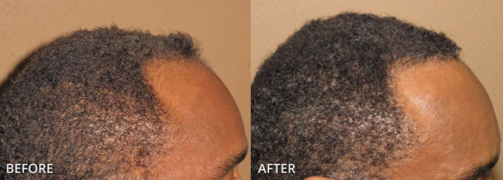 FUE Hair Transplantation – Before and After Pictures