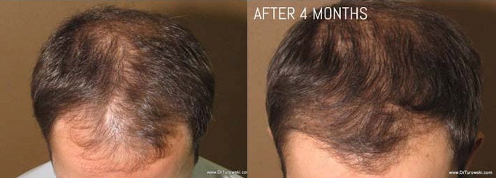 FUE Hair Transplantation – Before and After Pictures