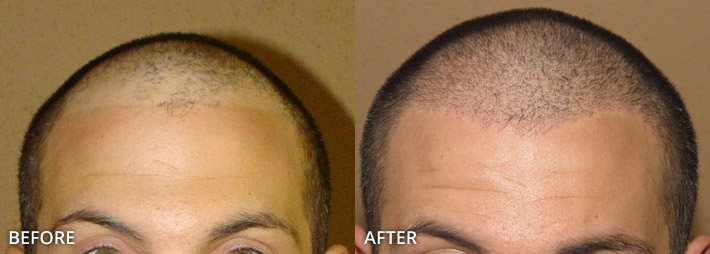 FUE Hair Transplantation – Before and After Pictures