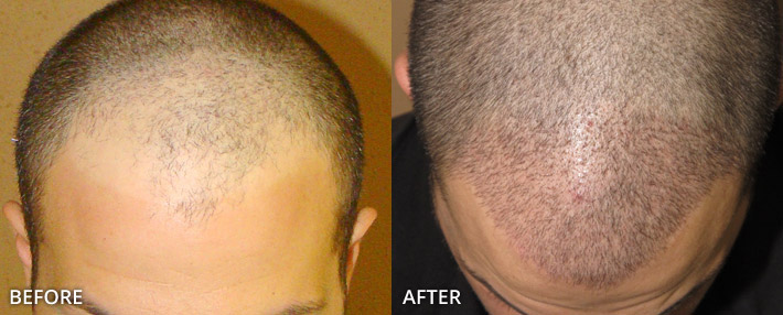 FUE Hair Transplantation – Before and After Pictures