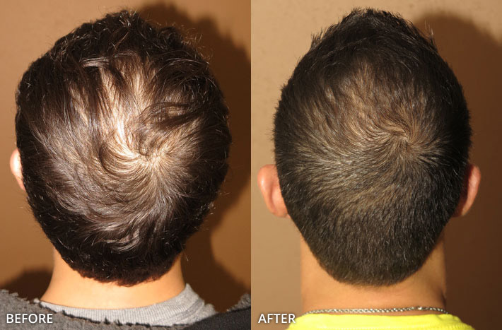 FUE Hair Transplantation – Before and After Pictures