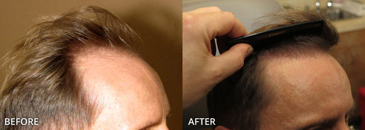 FUE Hair Transplantation – Before and After Pictures