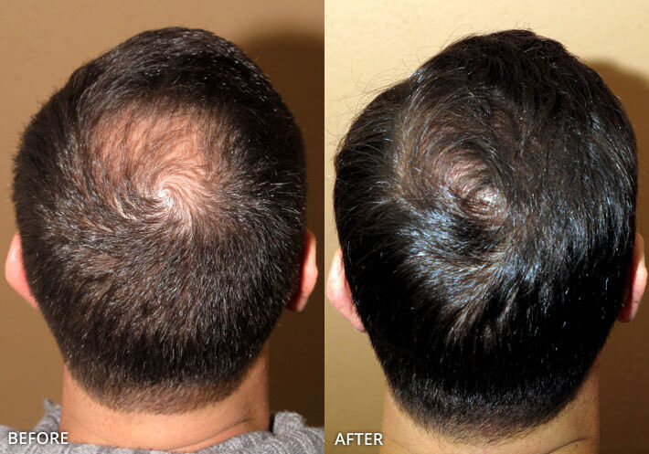 FUE Hair Transplantation – Before and After Pictures