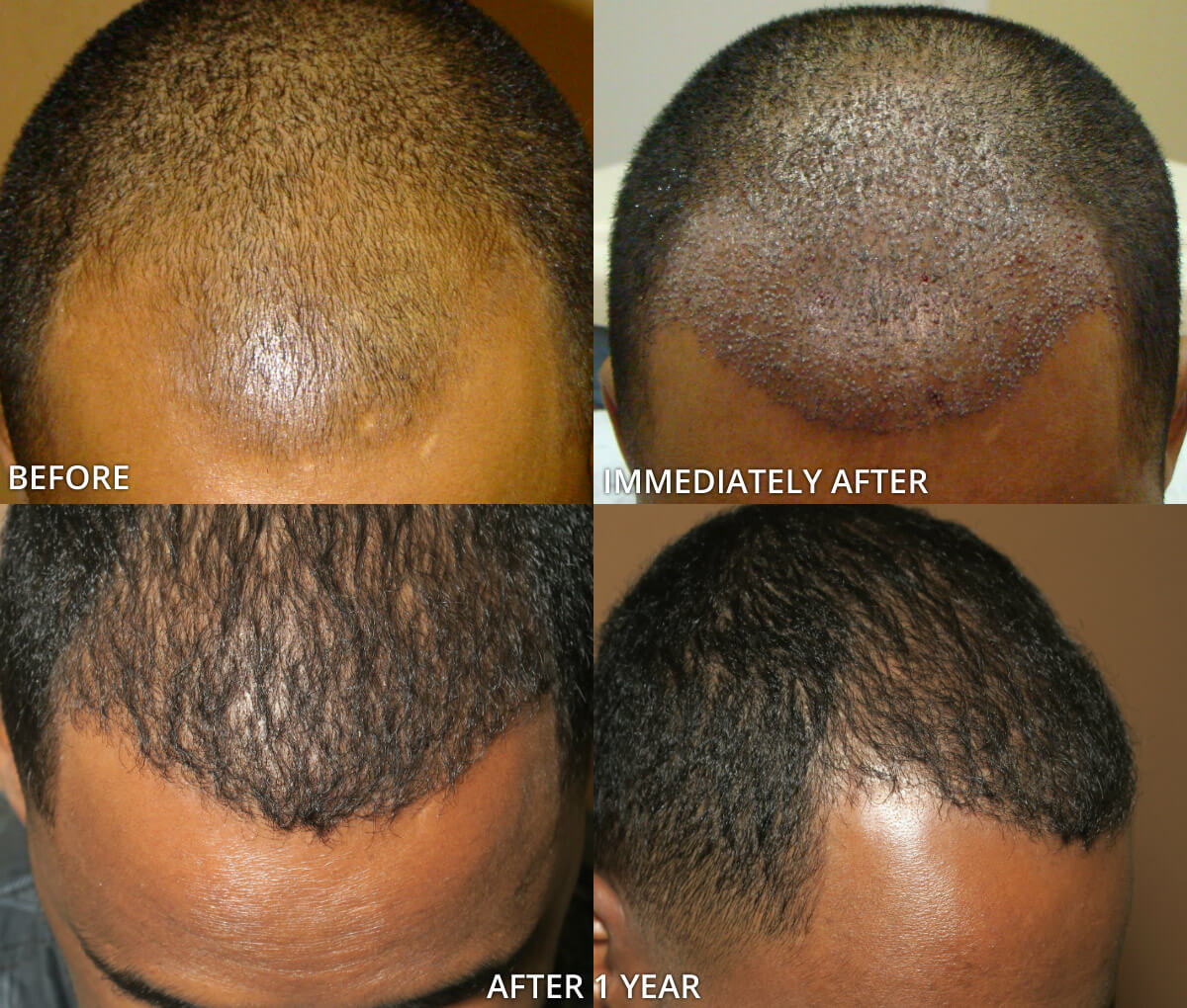 FUE Hair Transplantation – Before and After Pictures