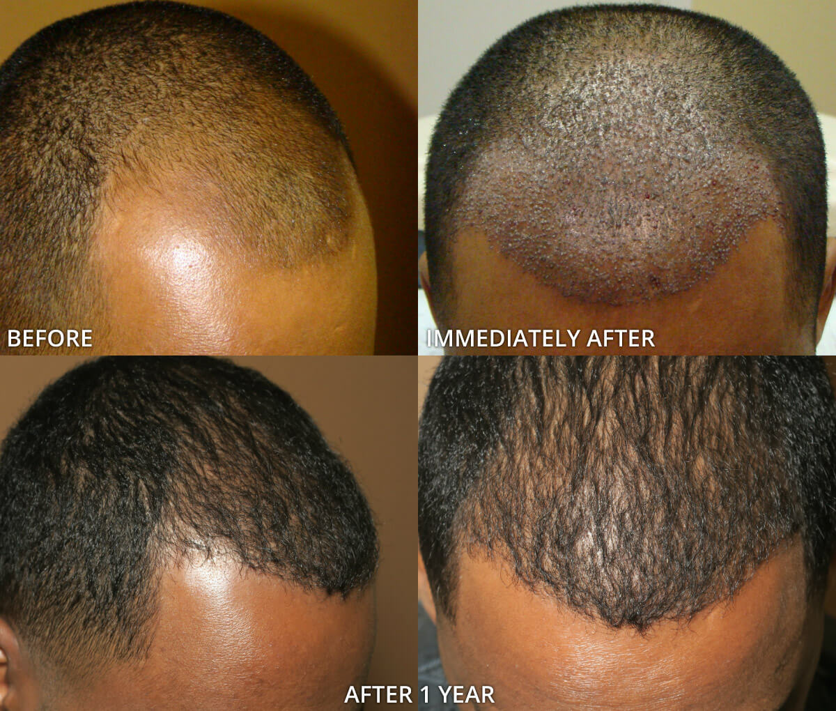 FUE Hair Transplantation – Before and After Pictures