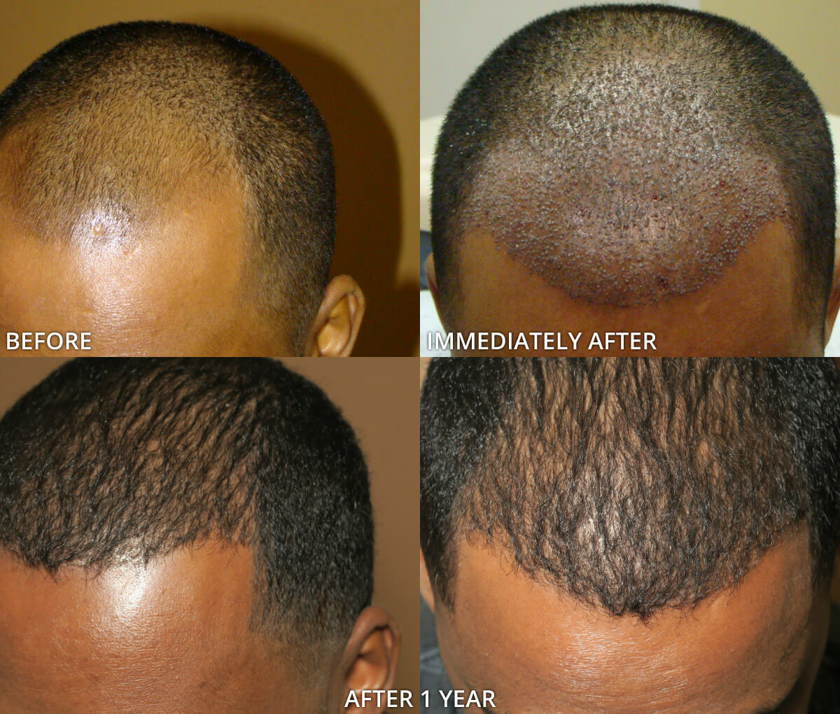 FUE Hair Transplantation – Before and After Pictures