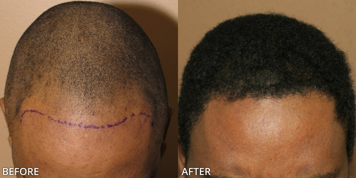 FUE Hair Transplantation – Before and After Pictures