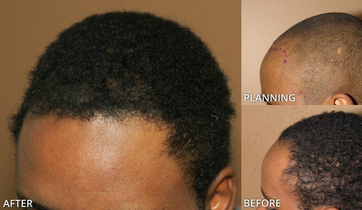 FUE Hair Transplantation – Before and After Pictures