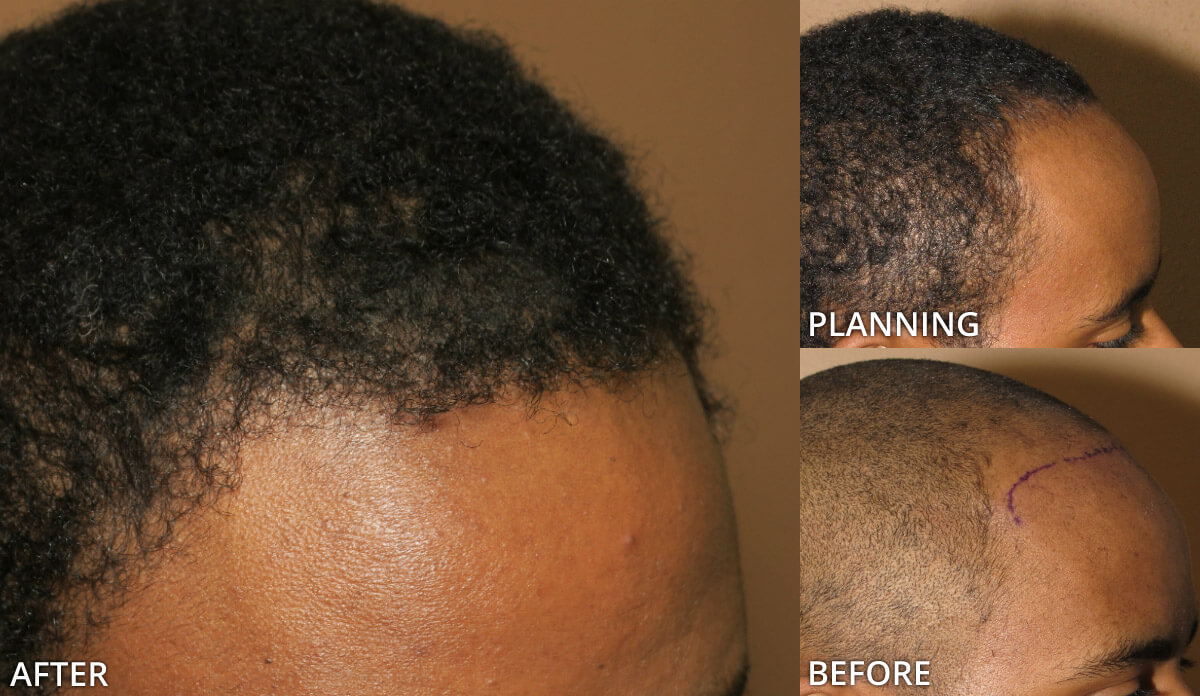 FUE Hair Transplantation – Before and After Pictures