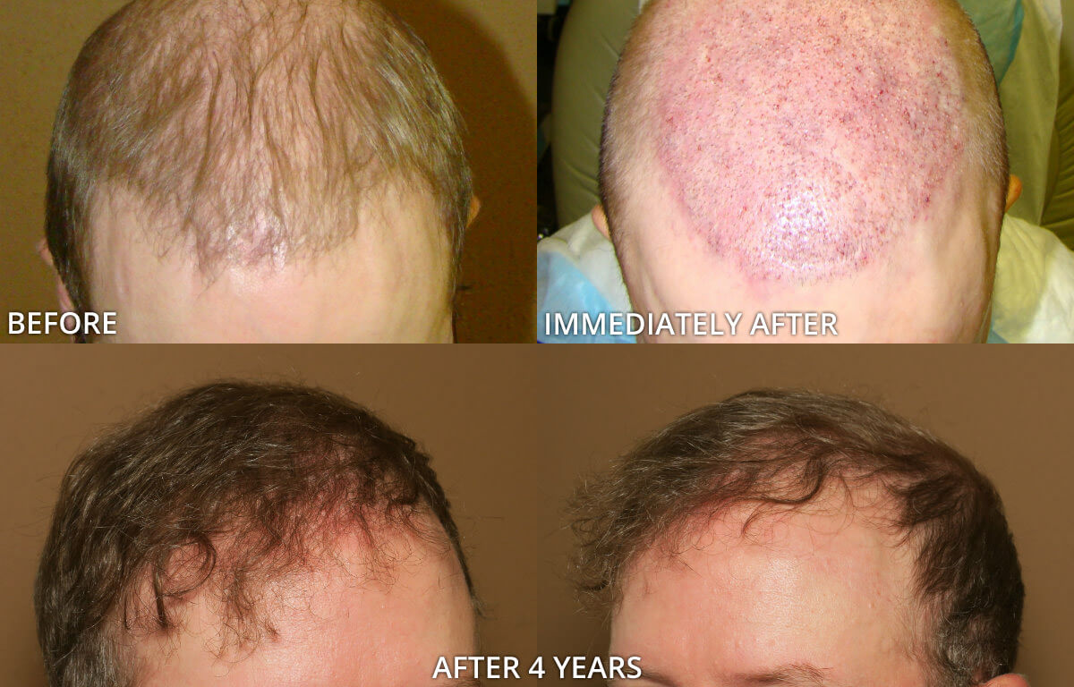 FUE Hair Transplantation – Before and After Pictures