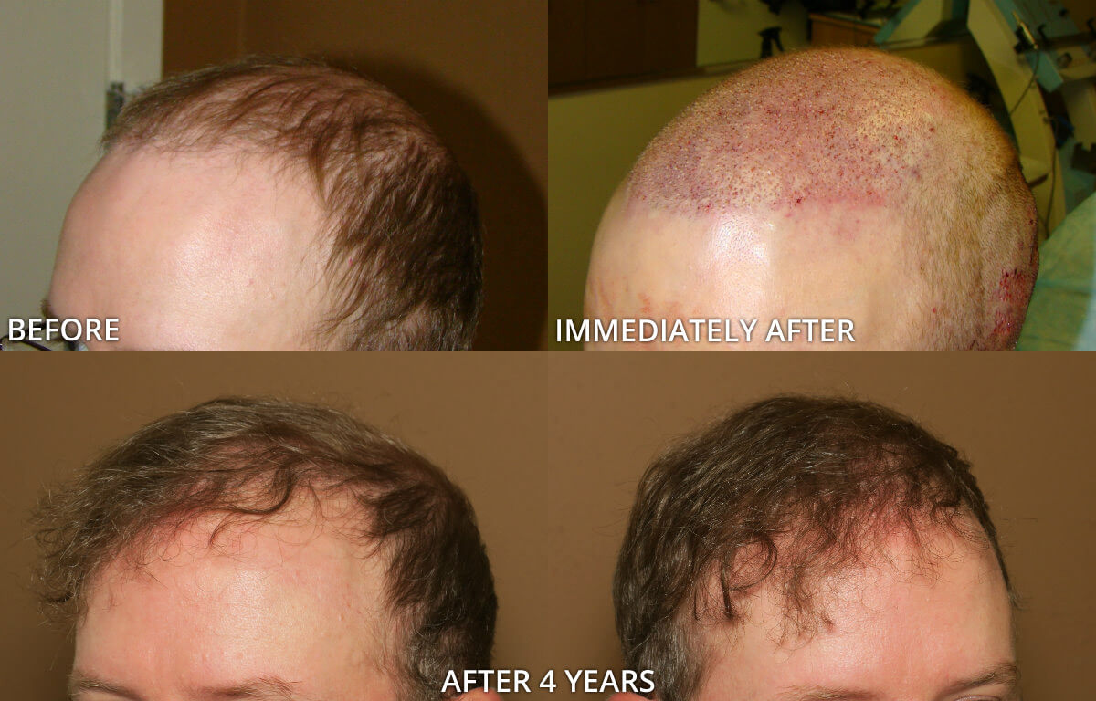 FUE Hair Transplantation – Before and After Pictures