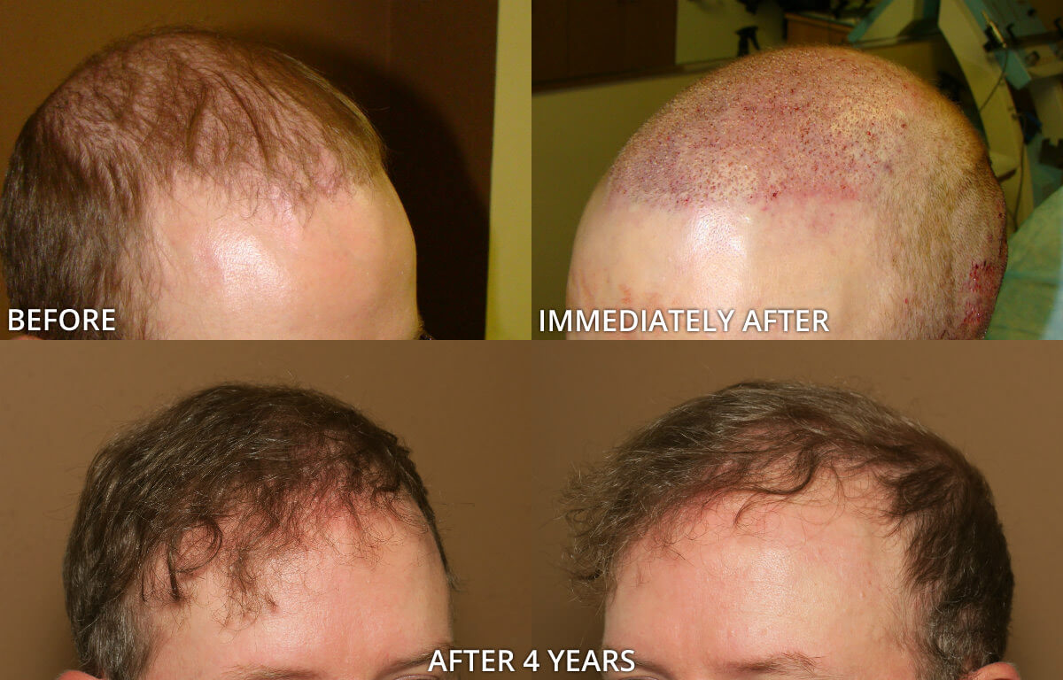 FUE Hair Transplantation – Before and After Pictures