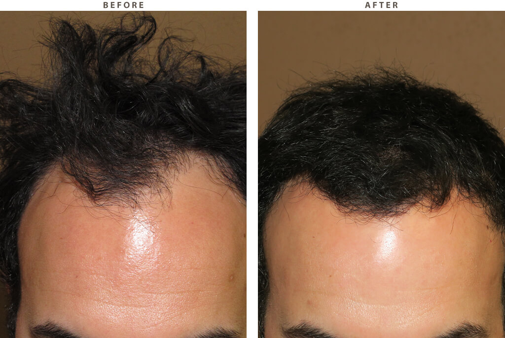 Hair Transplant - Before and After Pictures