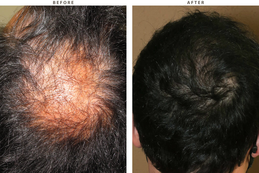 Hair Transplant - Before and After Pictures