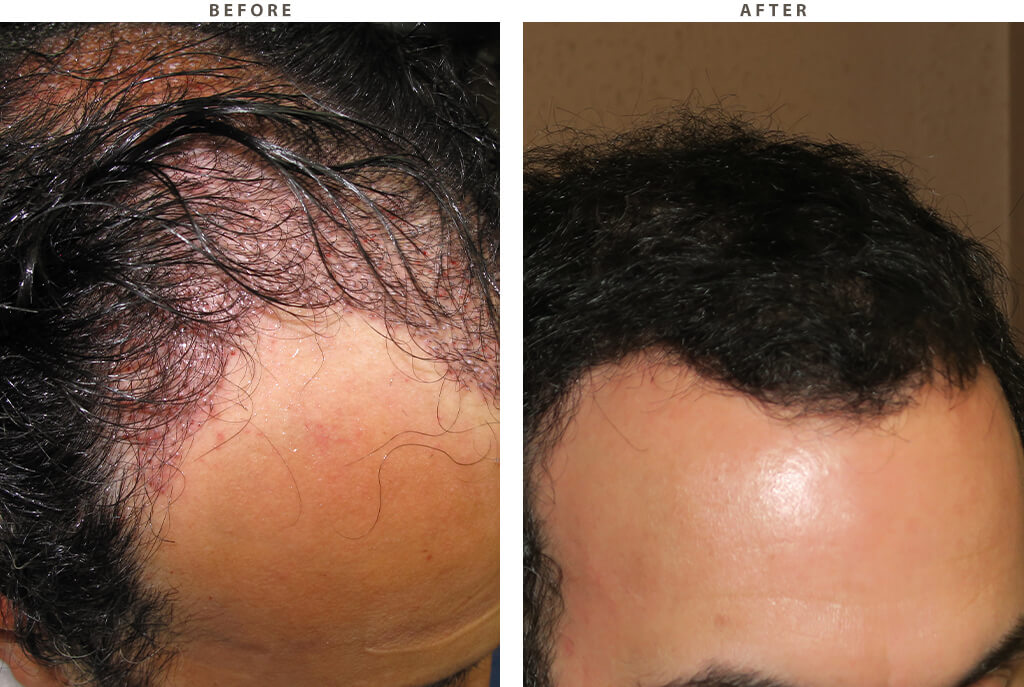 Hair Transplant - Before and After Pictures