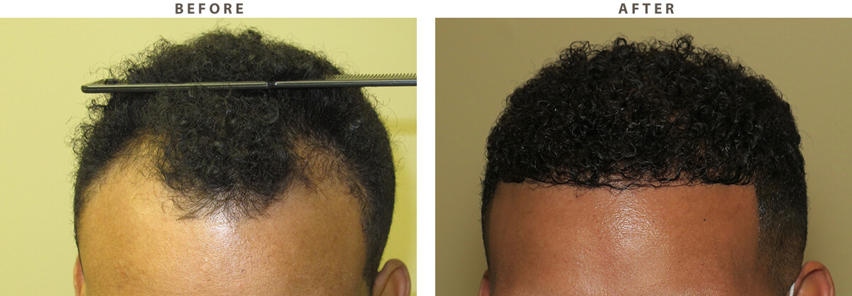 Hair Transplant - Before and After Pictures