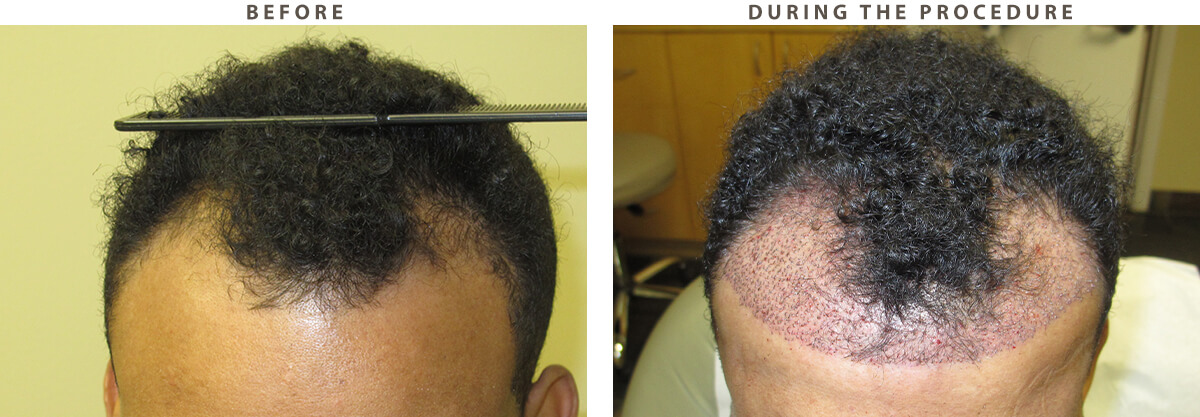 Hair Transplant - Before and After Pictures