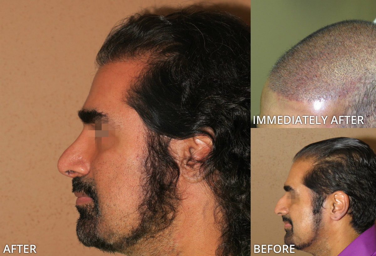 FUE Hair Transplantation – Before and After Pictures