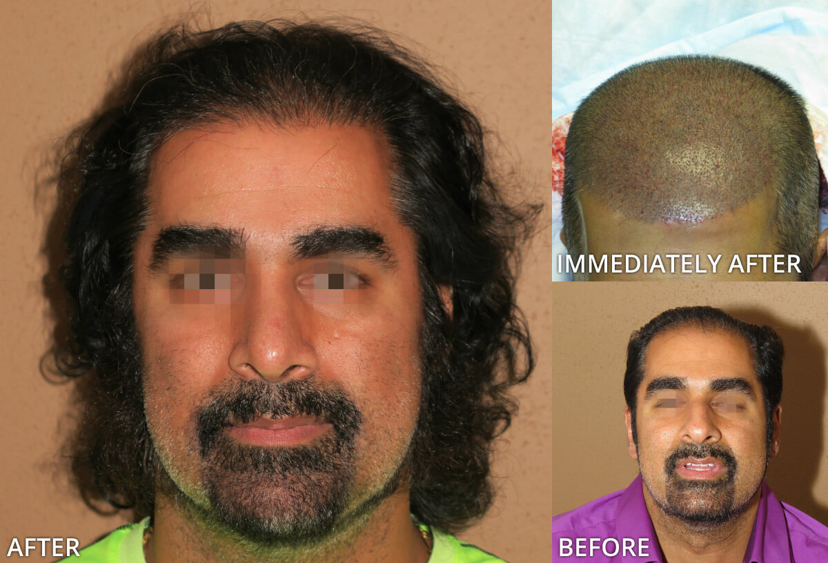 FUE Hair Transplantation – Before and After Pictures