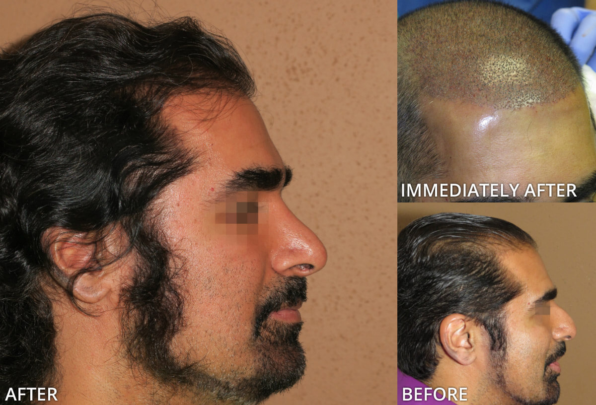 FUE Hair Transplantation – Before and After Pictures