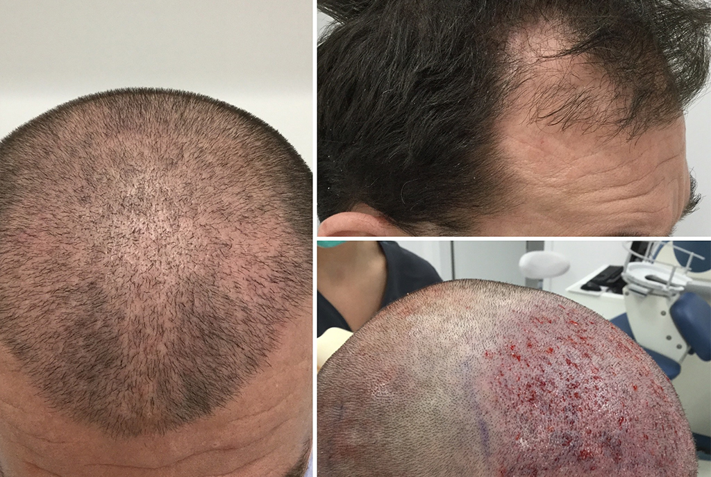 Hair Transplantation - Before and After Pictures