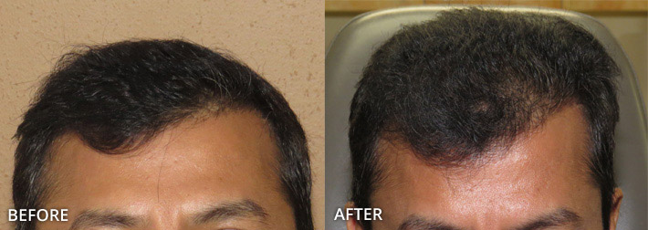 FUE Hair Transplantation – Before and After Pictures