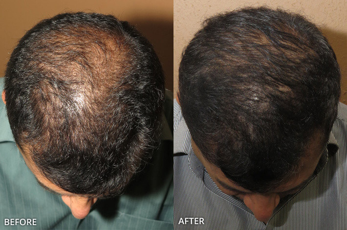 FUE Hair Transplantation – Before and After Pictures