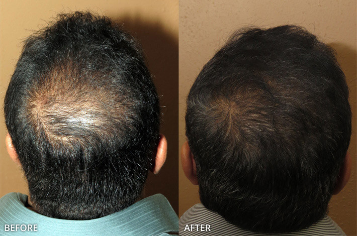 FUE Hair Transplantation – Before and After Pictures