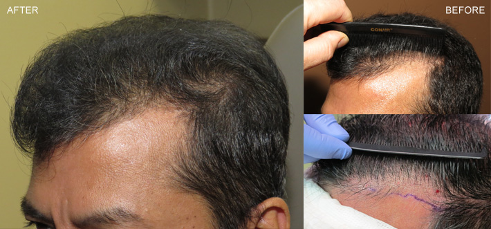 FUE Hair Transplantation – Before and After Pictures