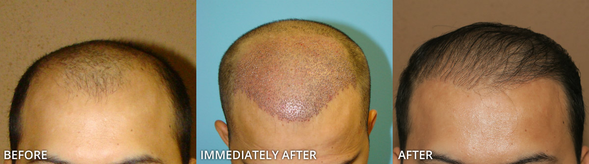 FUE Hair Transplantation – Before and After Pictures