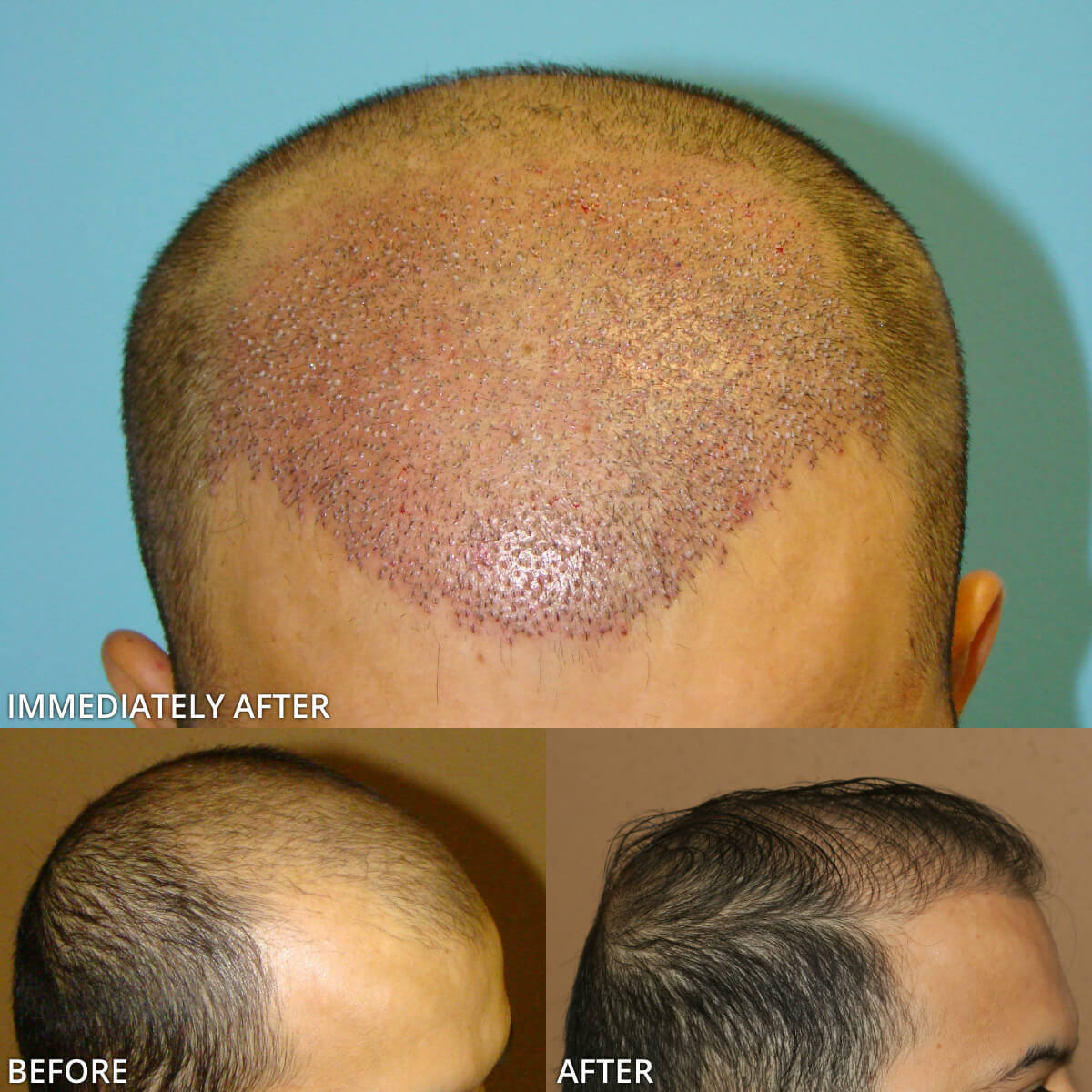 FUE Hair Transplantation – Before and After Pictures