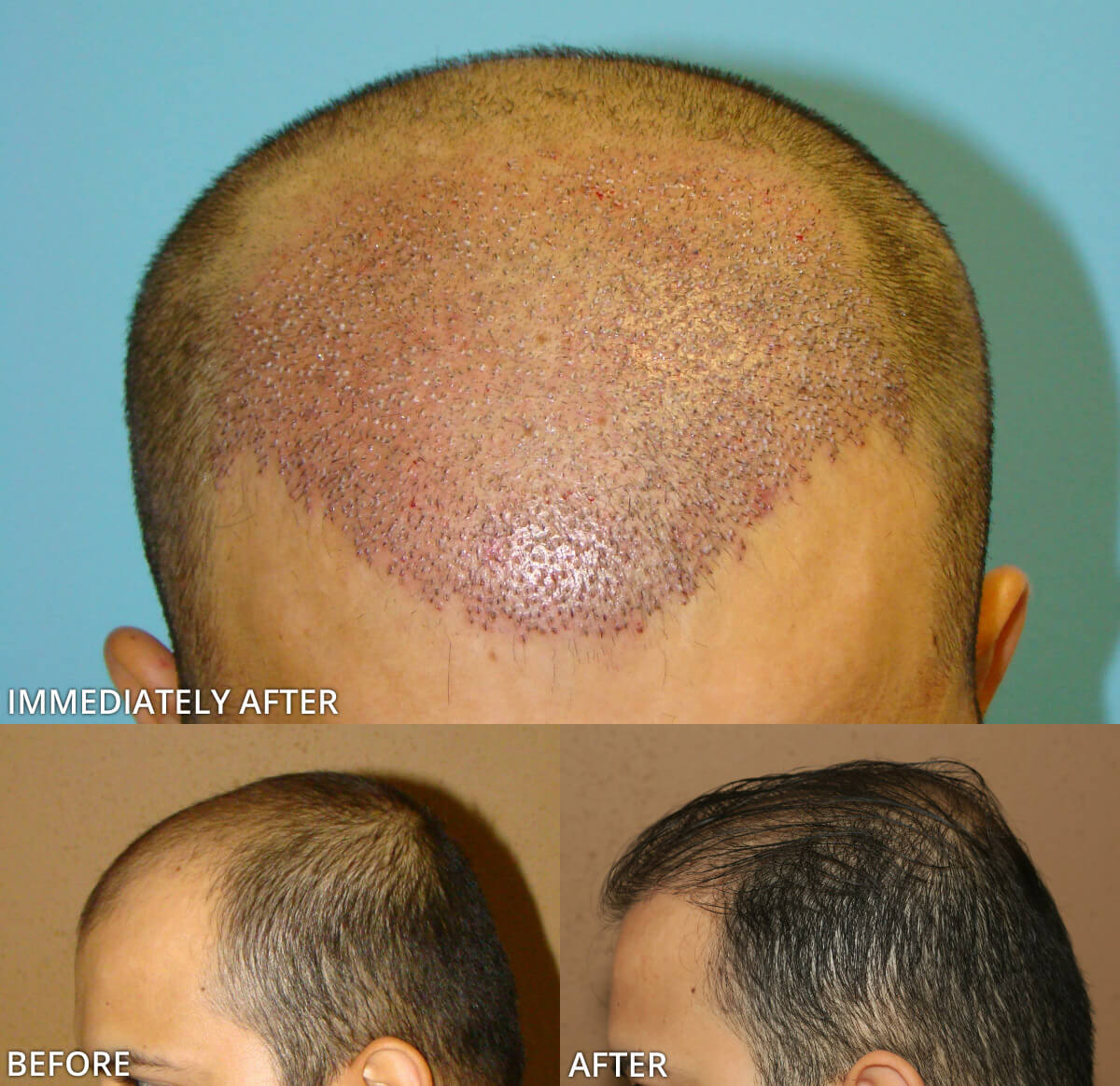 FUE Hair Transplantation – Before and After Pictures