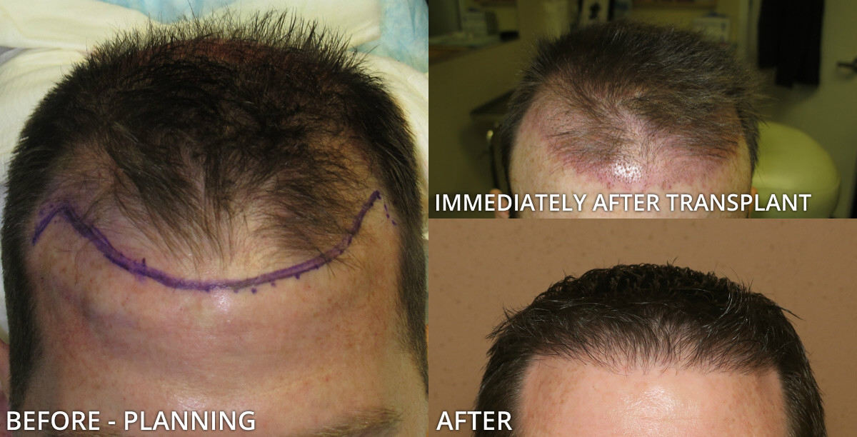 FUE Hair Transplantation – Before and After Pictures