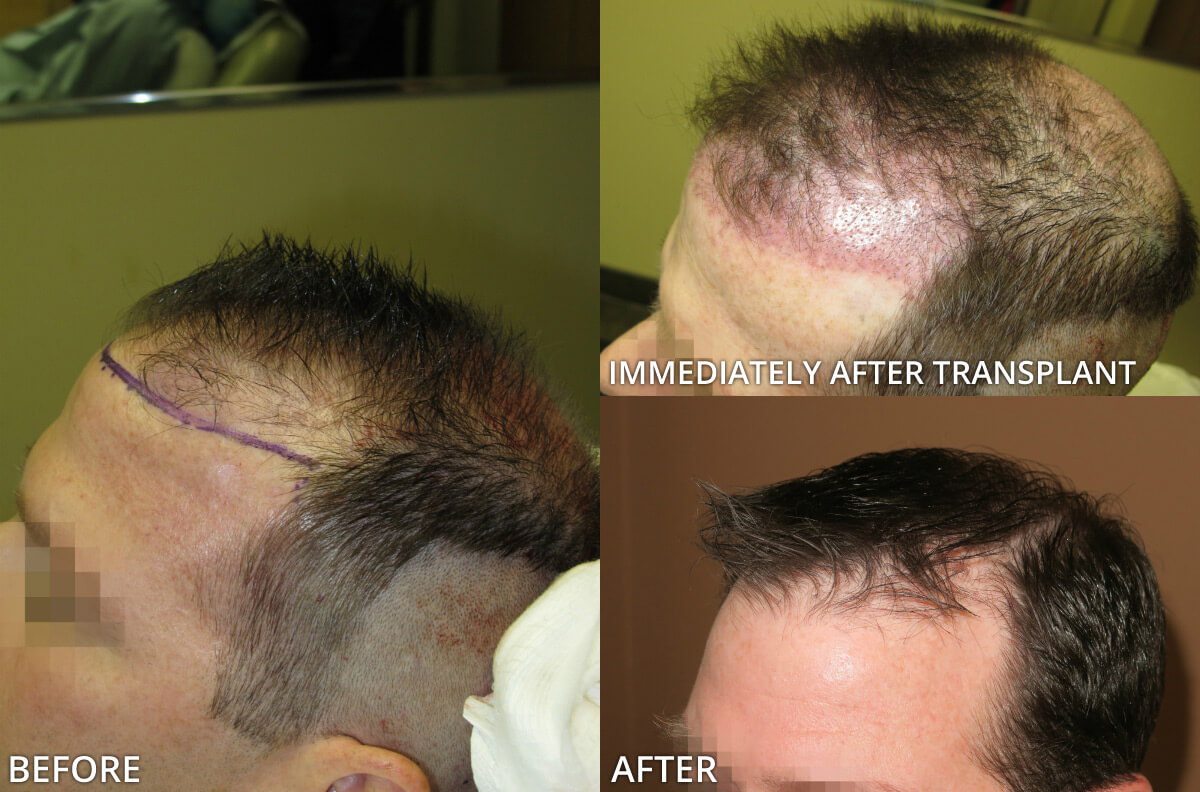 FUE Hair Transplantation – Before and After Pictures