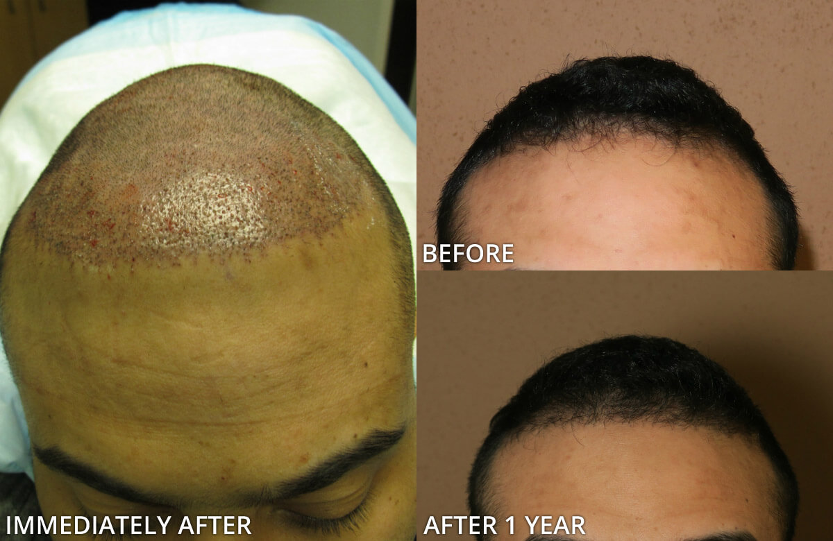 FUE Hair Transplantation – Before and After Pictures