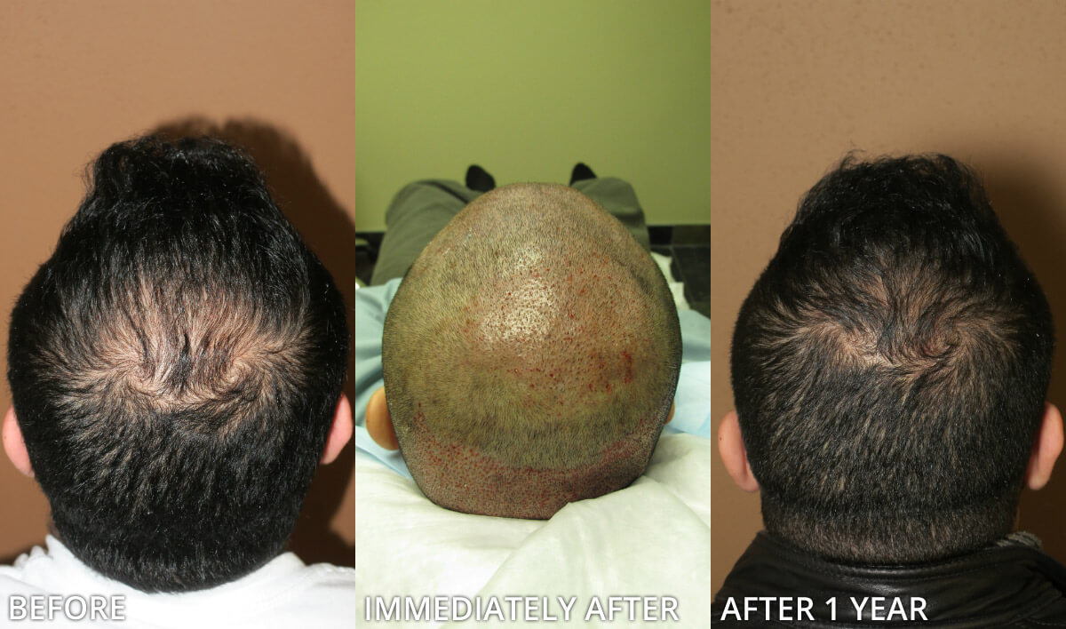 FUE Hair Transplantation – Before and After Pictures