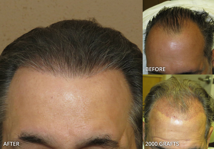 FUE Hair Transplantation – Before and After Pictures