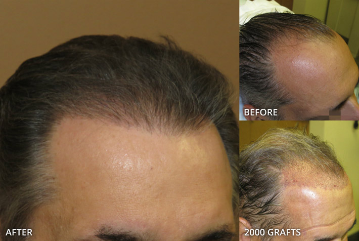 FUE Hair Transplantation – Before and After Pictures