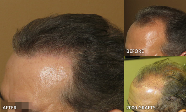 FUE Hair Transplantation – Before and After Pictures