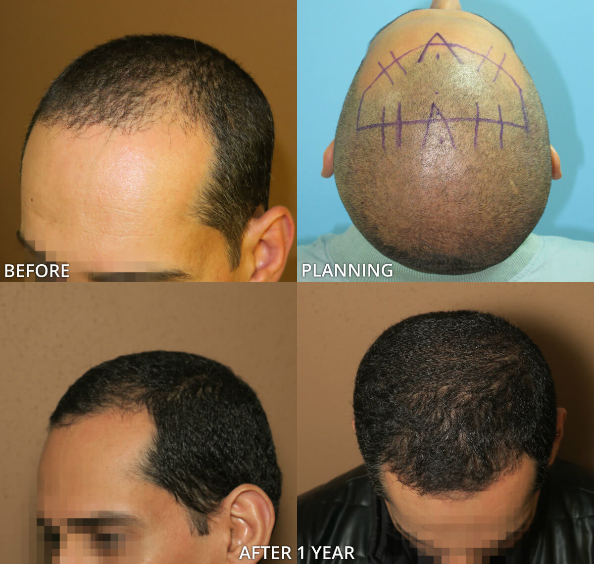 FUE Hair Transplantation – Before and After Pictures