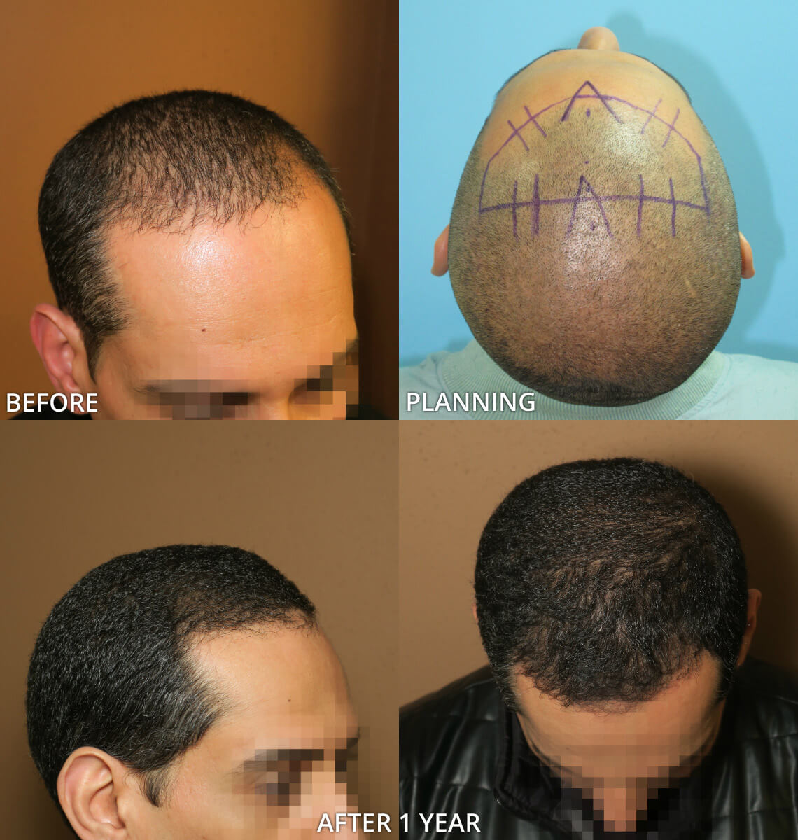 FUE Hair Transplantation – Before and After Pictures