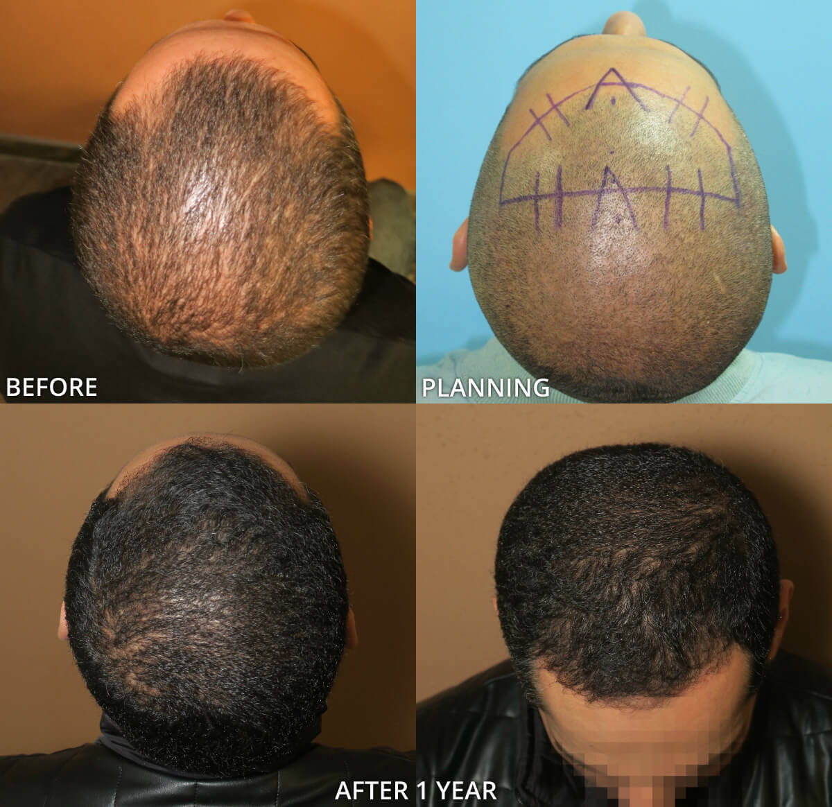 FUE Hair Transplantation – Before and After Pictures