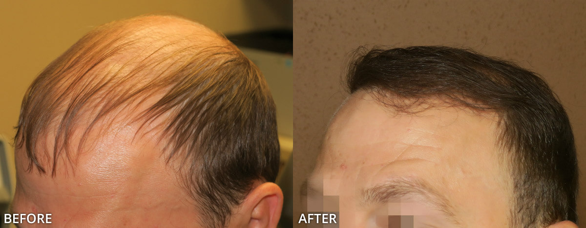 FUE Hair Transplantation – Before and After Pictures